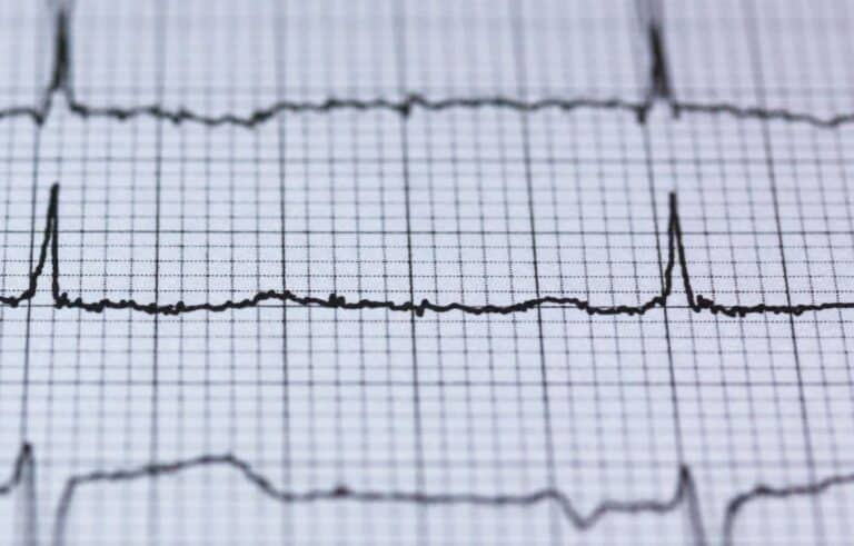 A black and white electrocardiogram (ECG) graph showing heart rhythm patterns