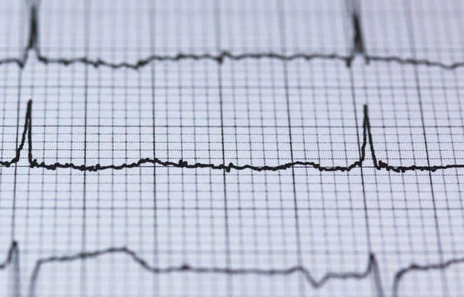 A black and white electrocardiogram (ECG) graph showing heart rhythm patterns
